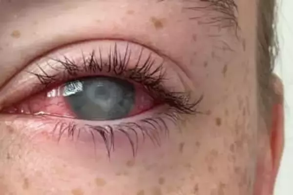 寄生アメーバが引き起こす角膜炎、失明の恐れも　コンタクトレンズ利用者が感染防止のためにすべきこと