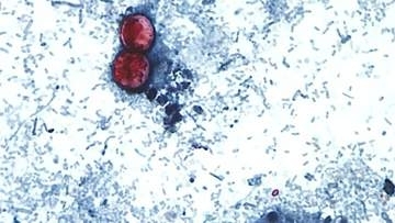 激しい下痢を起こす寄生虫感染症、米国で昨年をはるかに上回る症例数　野菜が原因との見方も