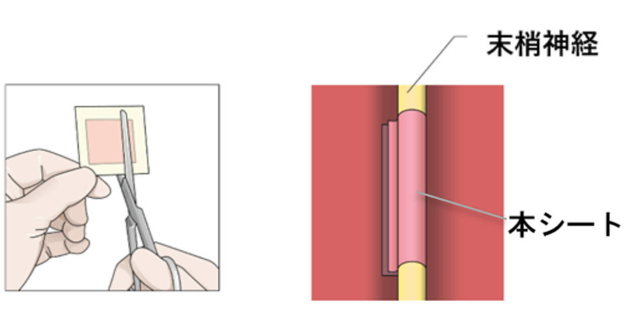 傷ついた末梢神経の再生を促す薬剤を含有したシート 阪大などが治験を実施 年10月25日 エキサイトニュース