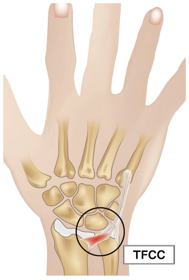 TFCC損傷という症状をご存知ですか？