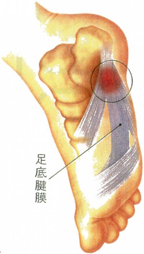 かかとの痛みの原因とは