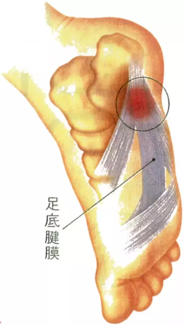 「かかとの痛みの原因とは」の画像