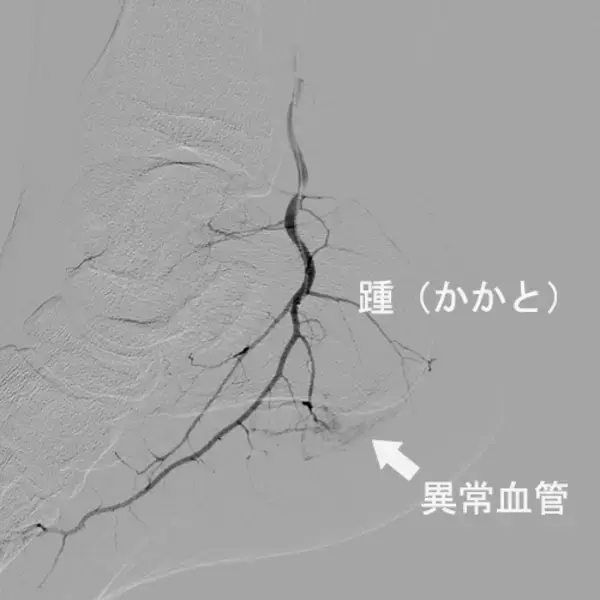 「かかとの痛みの原因とは」の画像