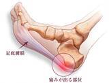「足底腱膜炎という症状をご存知ですか？」の画像1
