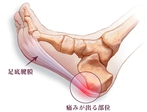 足底腱膜炎という症状をご存知ですか？