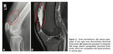 「【医師に相談】膝関節血腫とはどのような病気ですか？」の画像3