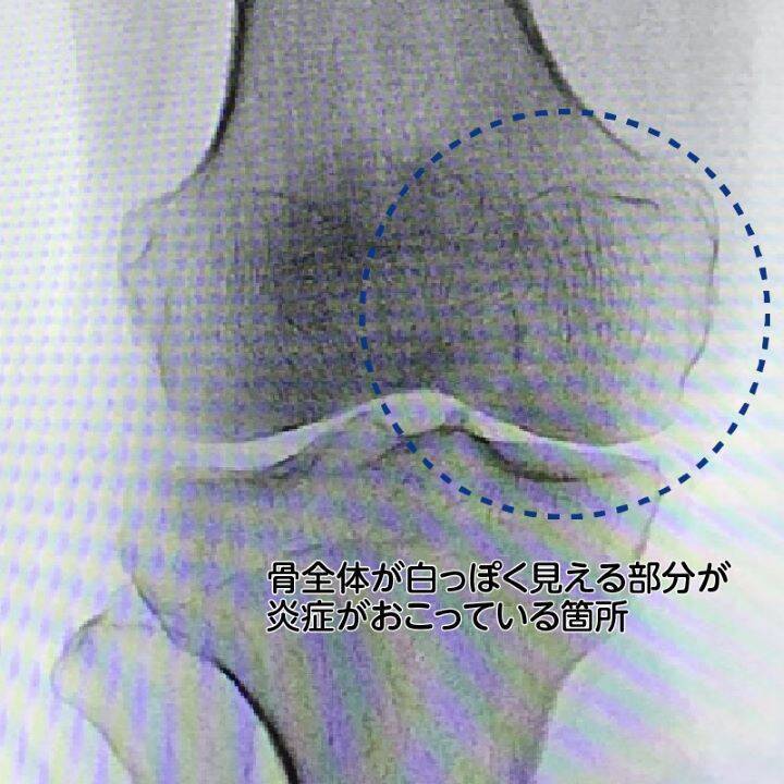【医師に相談】変形性膝関節症とは何ですか？