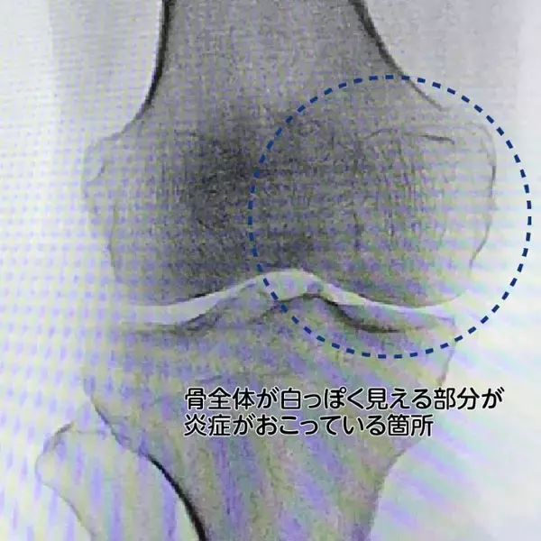「【医師に相談】変形性膝関節症とは何ですか？」の画像