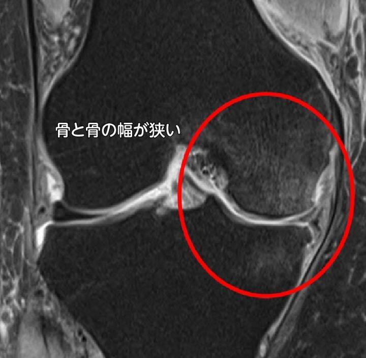 【医師に相談】変形性膝関節症とは何ですか？