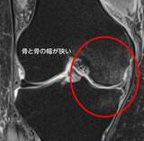 「【医師に相談】変形性膝関節症とは何ですか？」の画像3