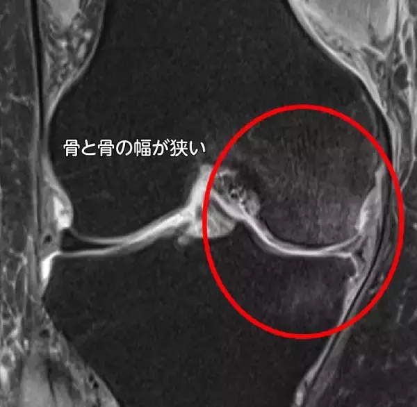 「【医師に相談】変形性膝関節症とは何ですか？」の画像