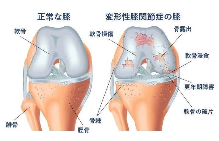 【医師に相談】変形性膝関節症とは何ですか？