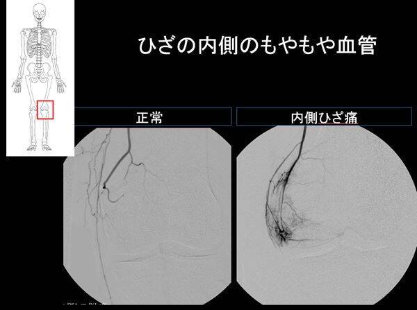 【医師に相談】変形性膝関節症とは何ですか？