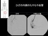 「【医師に相談】変形性膝関節症とは何ですか？」の画像5