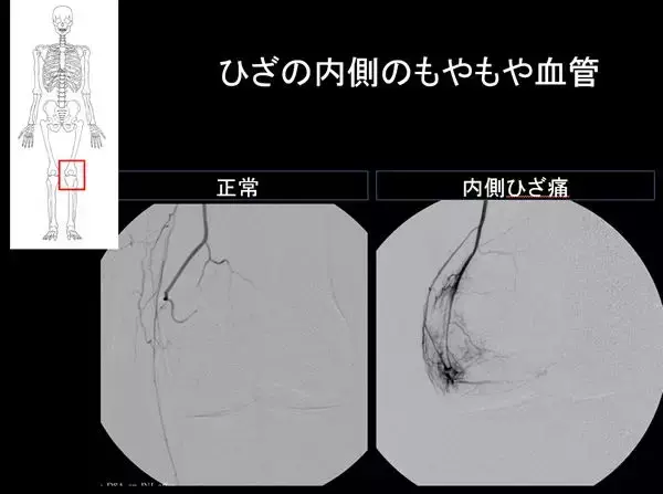 「【医師に相談】変形性膝関節症とは何ですか？」の画像