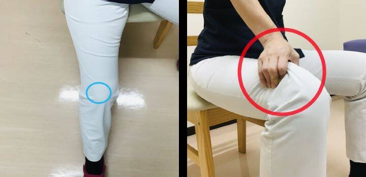 【医師に相談】変形性膝関節症とは何ですか？