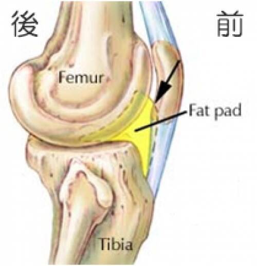 見逃されている痛みの原因 膝蓋下脂肪体 って知ってる 21年6月27日 エキサイトニュース