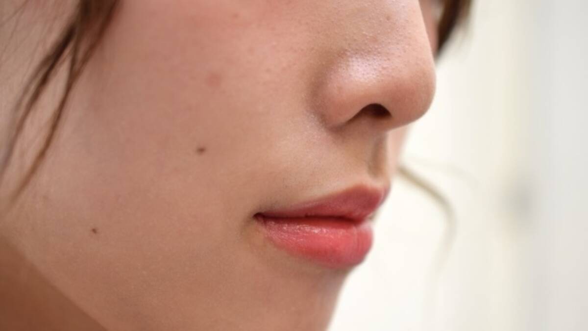 ほくろが多い 増える場合に気をつけるべき病気とは 21年5月24日 エキサイトニュース