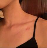 「宇多田ヒカル、息子に噛まれて「キスマークにしかみえない」」の画像1