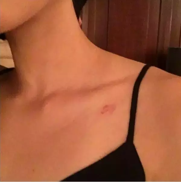 宇多田ヒカル、息子に噛まれて「キスマークにしかみえない」