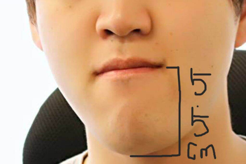 しゃくれ男子が顎を整形すると顔は改善されるのか 17年5月26日 エキサイトニュース