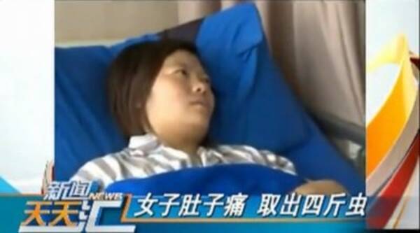 閲覧注意 カエルの生肉が好物で 中国人女性の体内から 寄生虫4キロ 摘出 16年8月4日 エキサイトニュース