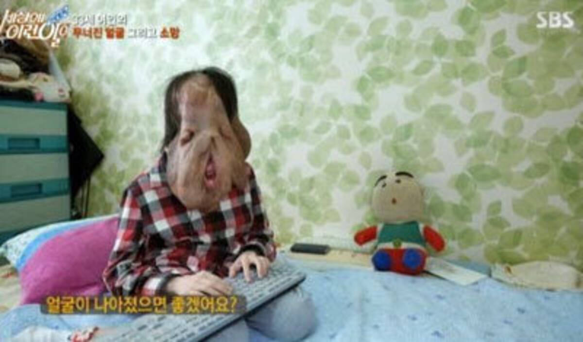 垂れた皮膚で顔が覆われた全盲の エレファントマン 女性に 1億円の募金集まる 16年11月6日 エキサイトニュース