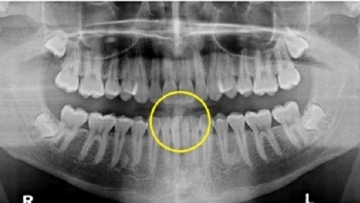 死亡の米大生「歯がズレた」原因は北朝鮮の拷問…裁判所が認定