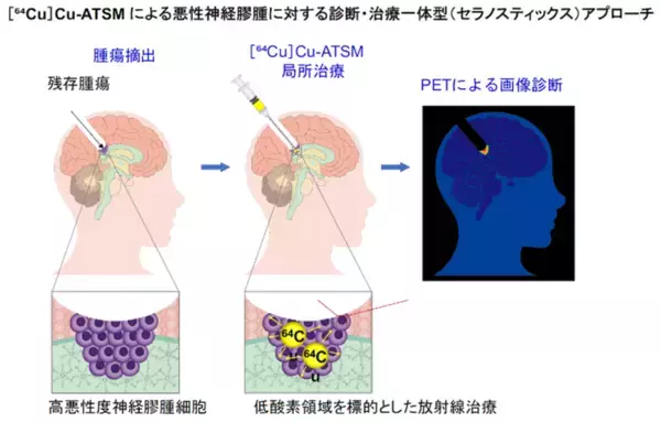 【横浜市立大学】悪性脳腫瘍に対する“低酸素領域標的型”局所放射線治療の有効性を実証