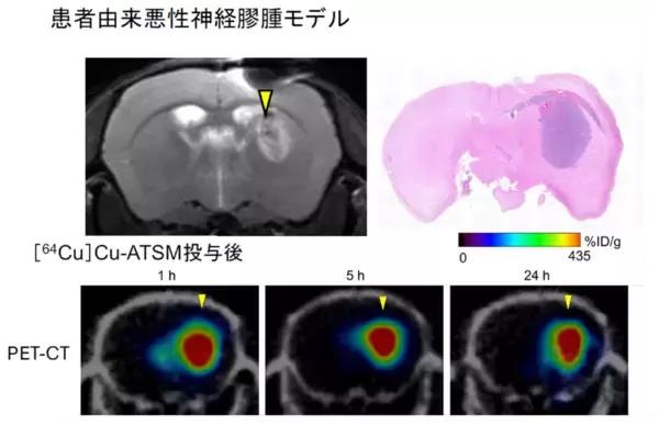 「【横浜市立大学】悪性脳腫瘍に対する“低酸素領域標的型”局所放射線治療の有効性を実証」の画像