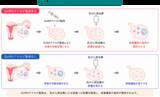 「若年女性がん患者の卵巣機能を守るために～卵巣保護目的のGnRHアナログ製剤、普及への課題が明らかに～」の画像1