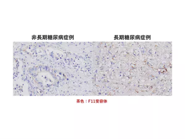 弘前大学の水上浩哉教授らの研究グループが長期糖尿病合併膵導管がんの新規発症機序を解明 ― MEG3、F11Rを標的とした新たな治療法の確立に期待