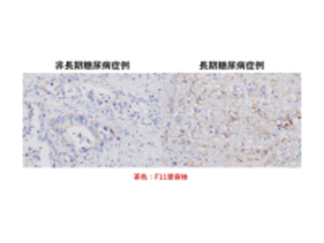 弘前大学の水上浩哉教授らの研究グループが長期糖尿病合併膵導管がんの新規発症機序を解明 ― MEG3、F11Rを標的とした新たな治療法の確立に期待