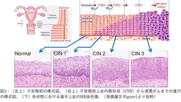 「深部異形成を非侵襲に捉える円偏光散乱(CiPLS)イメージング ―子宮頸がん前駆病変の非侵襲診断に向けて―（北里大学）」の画像