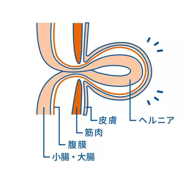 「6月1日は、自然治癒のない身近な疾患「鼠径ヘルニアの日」 小さなふくらみ、大きなサイン 症状があっても約7割が受診せず」の画像