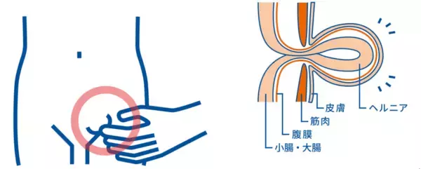 「6月1日は、自然治癒のない身近な疾患「鼠径ヘルニアの日」 小さなふくらみ、大きなサイン 症状があっても約7割が受診せず」の画像
