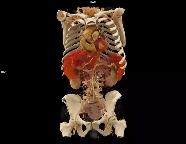 「シーメンスヘルスケア、フォトンカウンティングCT「NAEOTOM Alpha」を名古屋市立大学病院へ導入。最新デュアルソースの特性を活かした高精度な診断で地域医療へ貢献を目指す。」の画像