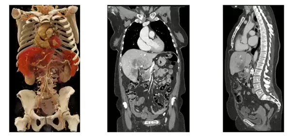 「シーメンスヘルスケア、フォトンカウンティングCT「NAEOTOM Alpha」を名古屋市立大学病院へ導入。最新デュアルソースの特性を活かした高精度な診断で地域医療へ貢献を目指す。」の画像