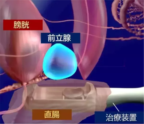 西日本初！先進医療 HIFU（ハイフ）を用いた前立腺がん局所療法を香大病院で開始