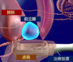 西日本初！先進医療 HIFU（ハイフ）を用いた前立腺がん局所療法を香大病院で開始