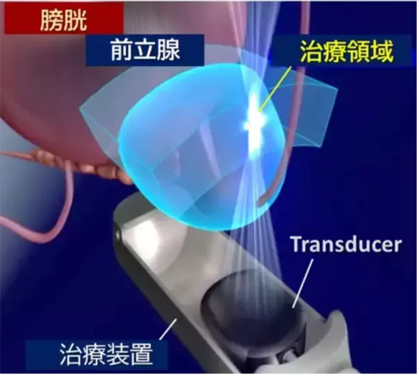 「西日本初！先進医療 HIFU（ハイフ）を用いた前立腺がん局所療法を香大病院で開始」の画像