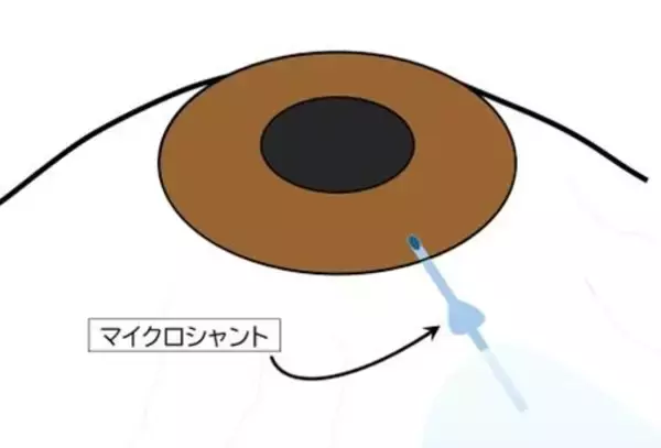 「【名古屋大学】緑内障インプラント（マイクロシャント）の術後管理に新知見 ～マイクロシャント露出時は油性眼軟膏の使用を避けるべき～」の画像