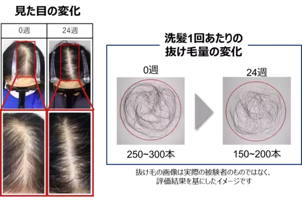 「【新知見】心身へのストレスによる抜け毛の増加（休止期脱毛症）に発毛成分「ミノキシジル」が有用な可能性を見出す」の画像