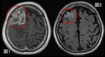 膠芽腫の画像起源の解明～いつから腫瘍は存在していたのか？～（北里大学）