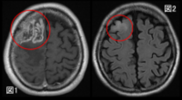 膠芽腫の画像起源の解明～いつから腫瘍は存在していたのか？～（北里大学）