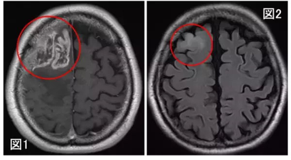「膠芽腫の画像起源の解明～いつから腫瘍は存在していたのか？～（北里大学）」の画像