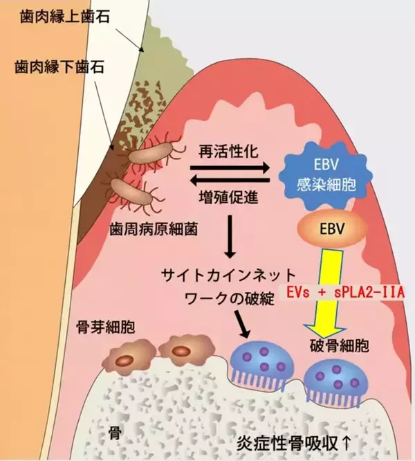 「【日本大学】歯周病の増悪にウイルスが関与か」の画像