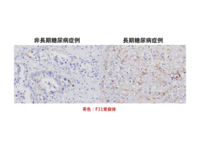 弘前大学の水上浩哉教授らの研究グループが長期糖尿病合併膵導管がんの新規発症機序を解明 ― MEG3、F11Rを標的とした新たな治療法の確立に期待