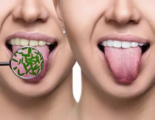 舌が白いと口臭が発生⁉ 舌苔の除去方法をチェック