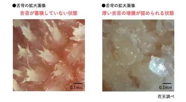 「舌が白いと口臭が発生⁉ 舌苔の除去方法をチェック」の画像